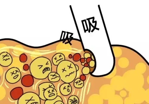 抽脂手术对身体有什么影响?抽脂手术适合哪些人